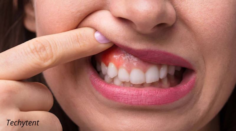 5 Ways How to Treat Tooth Abscess